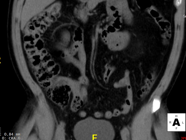 Ct Scan Colon Cancer Screening ct scan machine